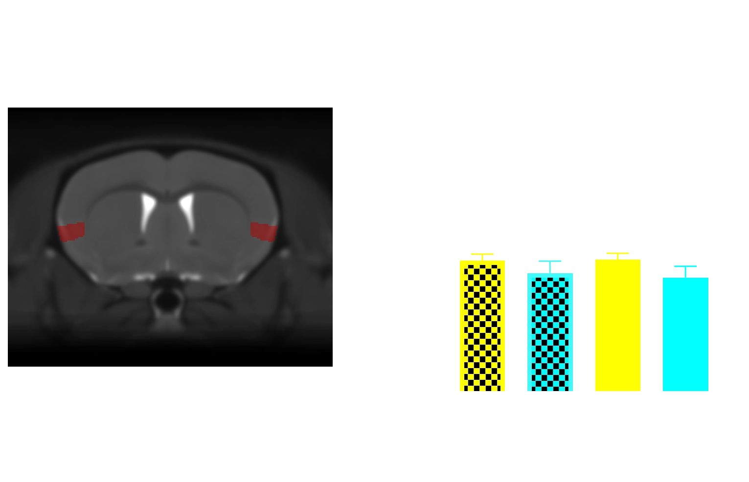 MRI Atlas and Regional Volume in insula