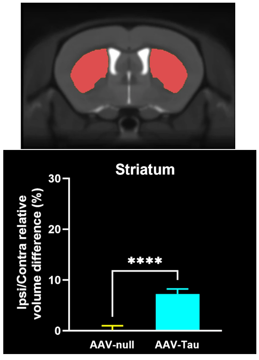 MRI Atlas and Volume Data at Striatum Level