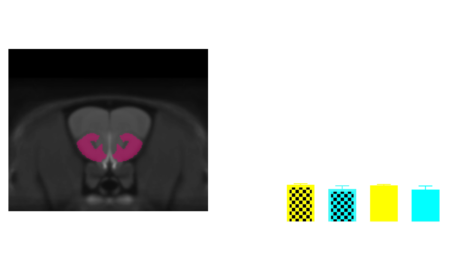 MRI Atlas and Regional Volume in AON